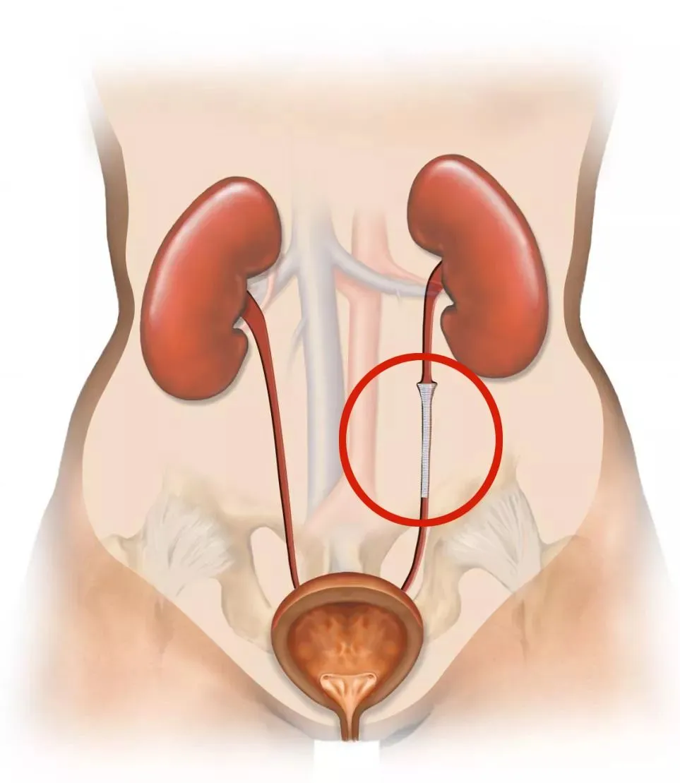 NiTi shape memory alloy ureteral stent